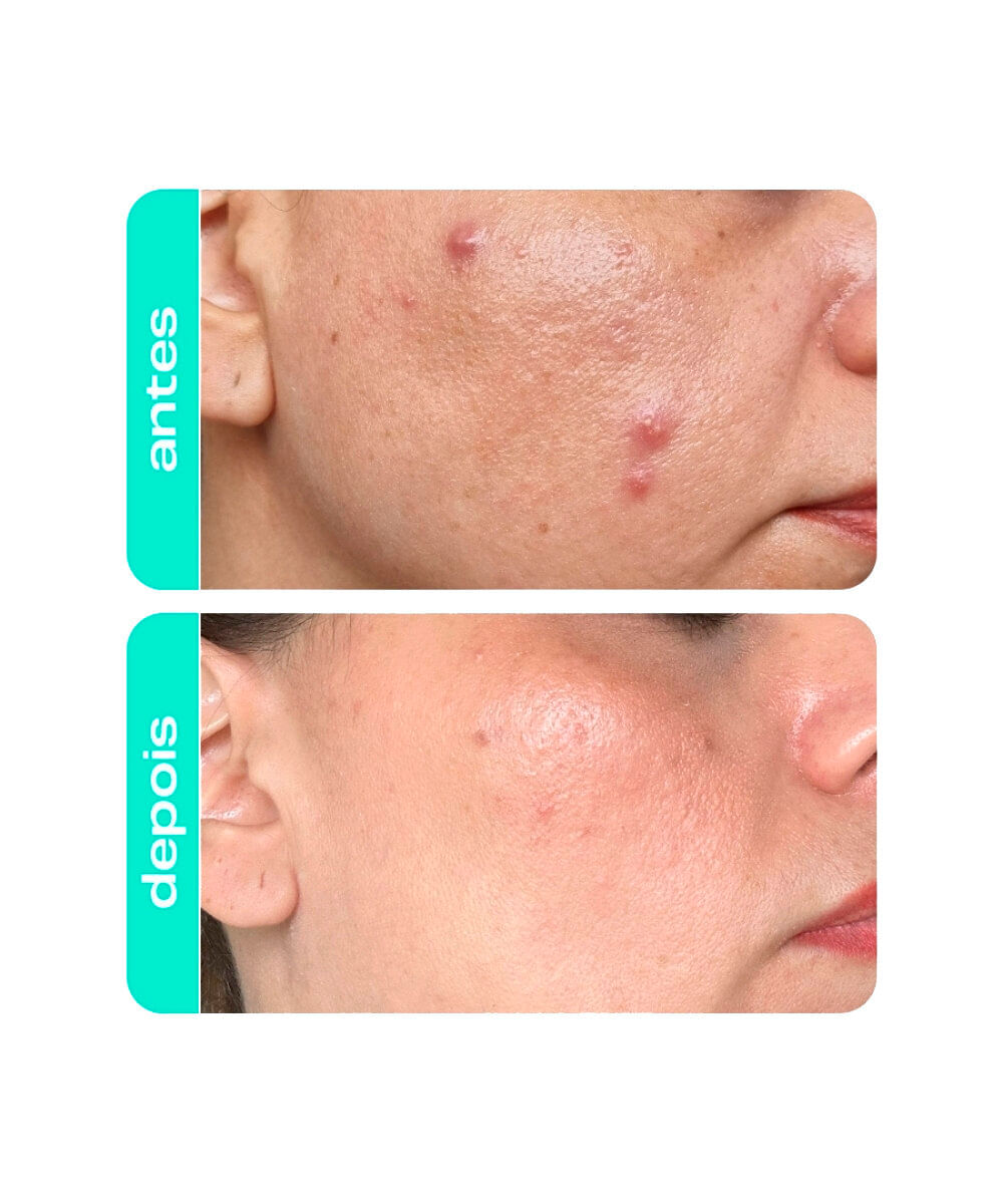 tônico facial creamy antiacne acido salicílico 90ml