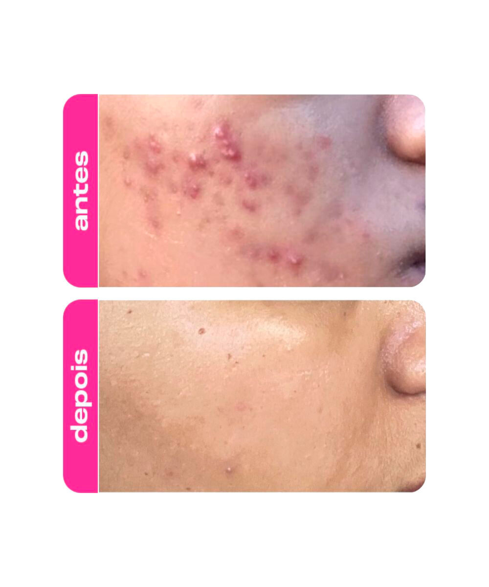 gel facial creamy clareador ácido mandélico 30g
